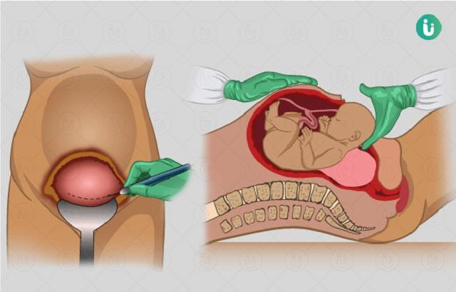 C-section डिलीवरी के बाद क्या-क्या परहेज करना चाहिए और कैसे जल्दी रिकवर करें