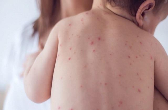 इस शहर में खतरनाक वायरस का कहर! 11 हजार बच्चों को लगे टीके