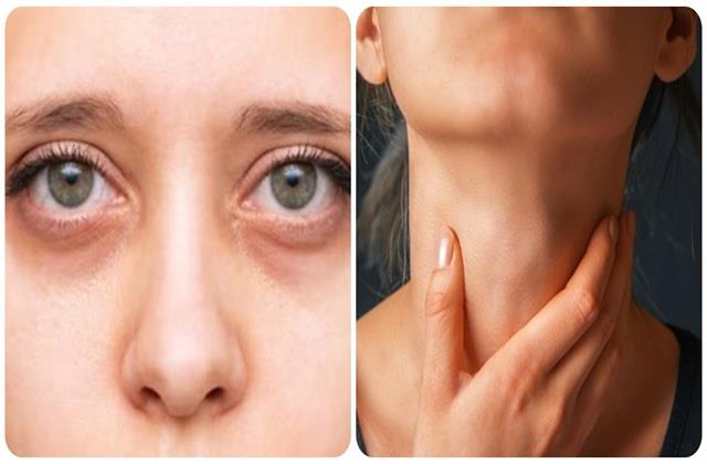 बार- बार सूज रही है आंखें? तो ये है थायरॉइड का पहला संकेत