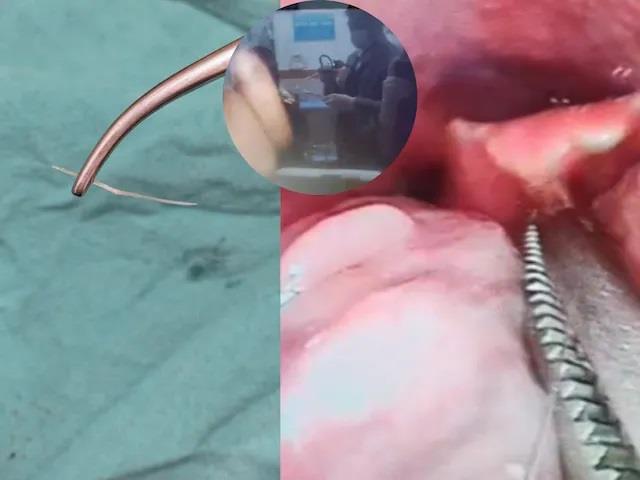 गले में फंसी मछली की हड्डी ने हराम कर दी रात, तड़पता रहा मरीज, डॉक्टरों ने बचाई जान