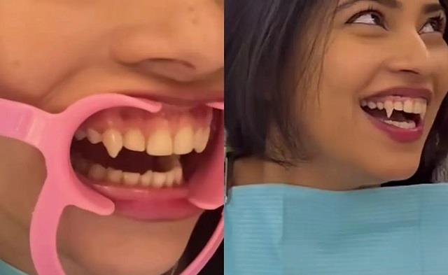Vampire Teeth: दुबई में ट्रेंड बन रहा नया शौक, इंस्टाग्राम पर वायरल हो रहा है वीडियो