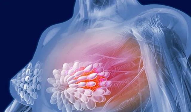 ब्रेस्ट कैंसर का रिस्क कम करती हैं ये 6 योगासन, हर महिला को जरूर करने चाहिए