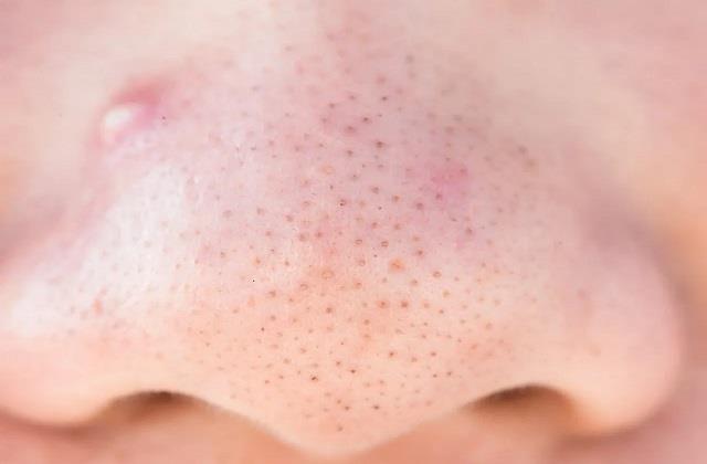 नाक पर दिखने वाले काले डॉट्स को ब्लैकहेड्स समझने की ना करें गलती, यहां समझिए पूरी बात