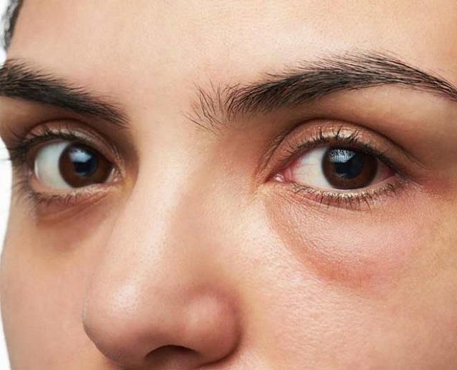 सुबह उठते ही चेहरा पर दिखे फेस Puffiness तो करें ये 3 चीजों का सेवन