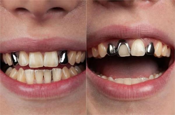 अब मुस्कुराना भी हुआ महंगा! चांदी के भाव ने बढ़ाई मरीजों की परेशानी