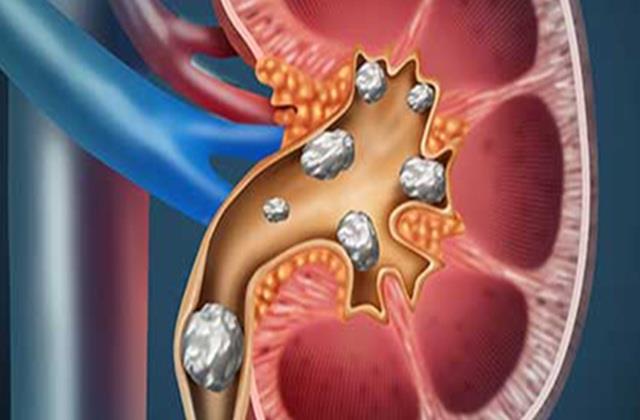 इन 3 बातों को गांठ बांध लें,  खुद ही निकल जाएगा किडनी में फंसा स्टोन !