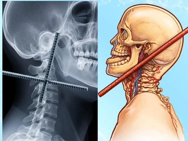 मौत को छूकर निकला शख्स, गर्दन से दिमाग तक आर-पार घुसा सरिया, देख डॉक्टर भी हैरान