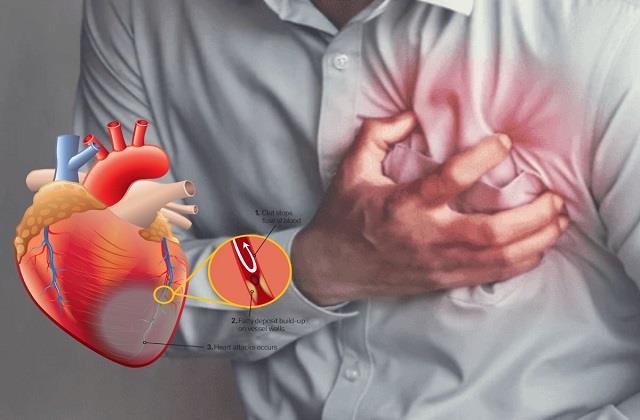 कौन-सी नस के ब्लॉक होने से आता है Heart Attack? ये लक्षण दिखें तो तुरंत हो जाएं सतर्क