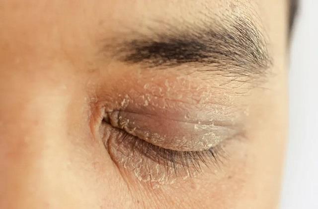 आंखों के आसपास की त्वचा हो रही है ड्राई? आज़माएं ये 5 असरदार घरेलू नुस्खे