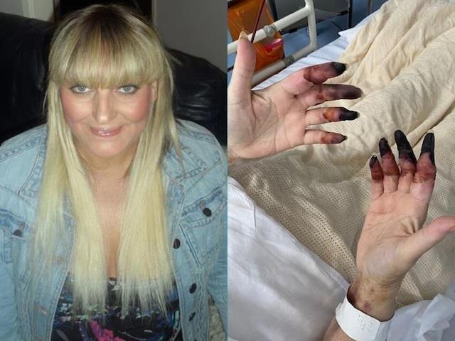 महिला को हुआ किडनी स्टोन का दर्द और काटनी पड़ गई 8 ऊंगलिया, खतरनाक बीमारी से हालत खराब