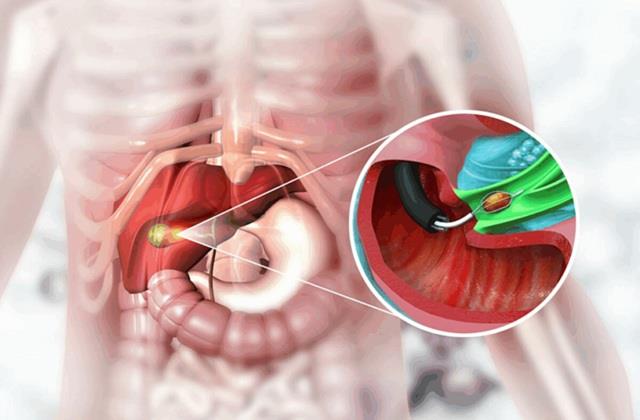 Gallbladder Surgery:  शरीर से पित्त की थैली निकलने के बाद दिखते हैं ये Side effects