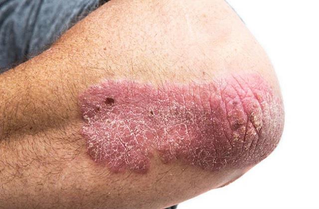 स्किन पर लाल चकत्ते दिखें तो भूलकर भी न खाएं ये चीजें, बढ़ सकती हैं मुसीबतें