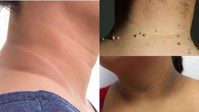 स्किन पर मस्से क्यों निकलते हैं? जानें वजह