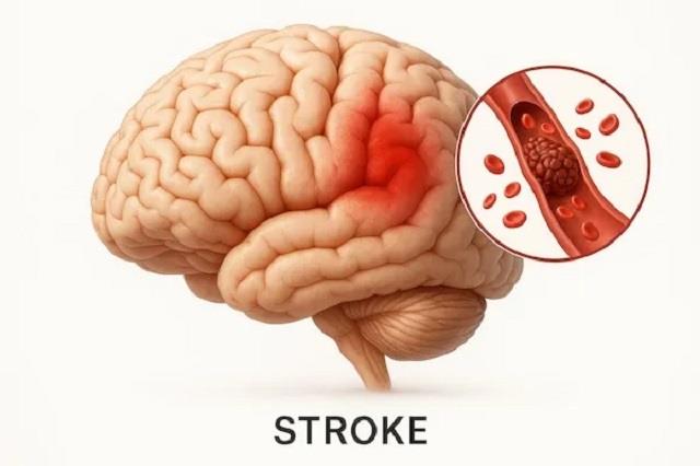 ब्रेन स्ट्रोक से बचने का फॉर्मूला- याद रखें 'BE FAST', बच सकती है जान