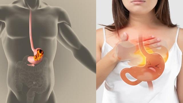 अगर लंबे समय तक एसिडिटी रहे तो हो सकती हैं ये गंभीर बीमारियां