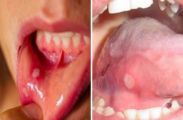 2 हफ्ते से ज्यादा रहने वाले छाले हो सकते हैं खतरनाक, जानिए कारण