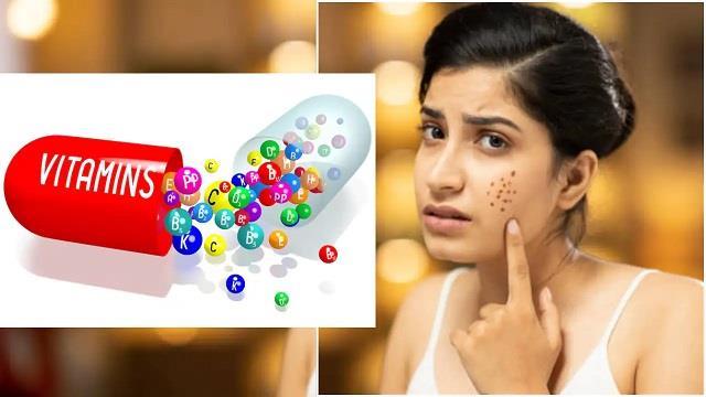 किस विटामिन की कमी से चेहरे पर होते हैं एक्ने और पिंपल्स? जानिए वजह
