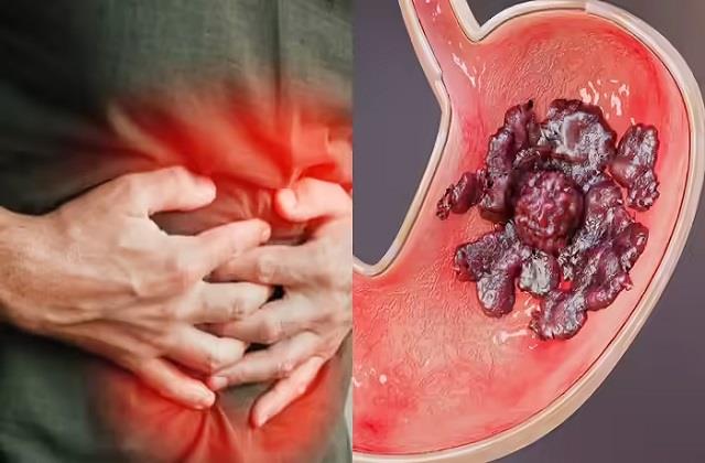 अल्ट्रासाउंड में भी पकड़ में नहीं आता पेट का अल्सर, जानें लक्षण और बचाव के तरीके