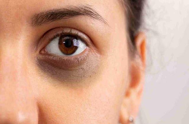 डार्क सर्कल्स से छुटकारा पाना है? घर में रखा ये तेल आंखों के नीचे के काले घेरे करेगा गायब