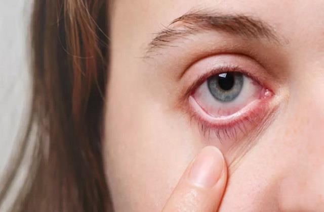 सर्दियों के बाद क्यों ड्राई हो जाती हैं आंखें? जानें Dry Eyes के कारण और उपाय