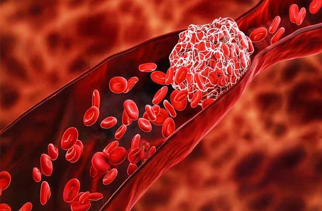 आपकी बॉडी में Blood Clot होने के संकेत, ऐसे लोगों का क्या खाना जरूरी
