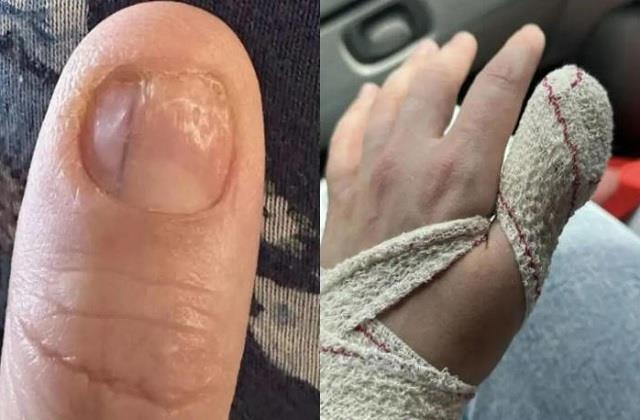 Acrylic Nails लगाने से महिला को हो गया खतरनाक Cancer, देखकर भी कर दी बड़ी गलती