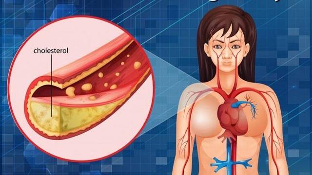 अगर बढ़ रहा है कोलेस्ट्रॉल तो सुबह खाली पेट पेट पिएं यह पानी, 2 महीने में दिखने लगेगा असर