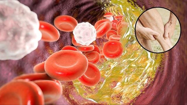 कोलेस्ट्रॉल बढ़ने पर शरीर में दिखने लगते हैं ये 5 बदलाव, तुरंत कराएं जांच