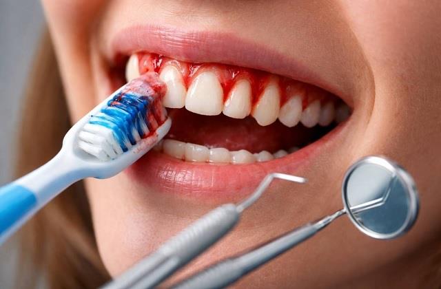 World Oral Health Day 2026: मसूड़ों से खून आना मामूली नहीं, दिल की बीमारी का संकेत