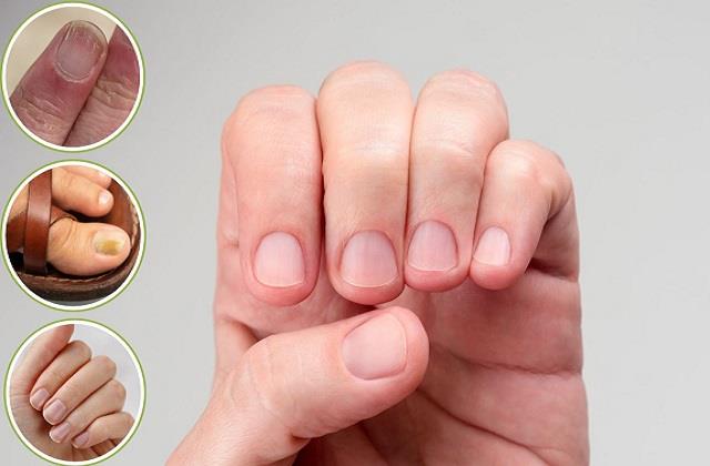 आपके नाखून बताते हैं इन गंभीर बीमारियों का राज
