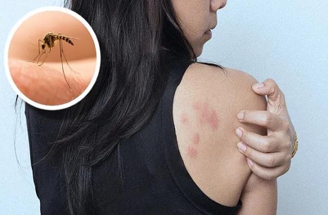 मच्छर काटने के बाद खुजली क्यों होती है? जानें इसके पीछे का कारण