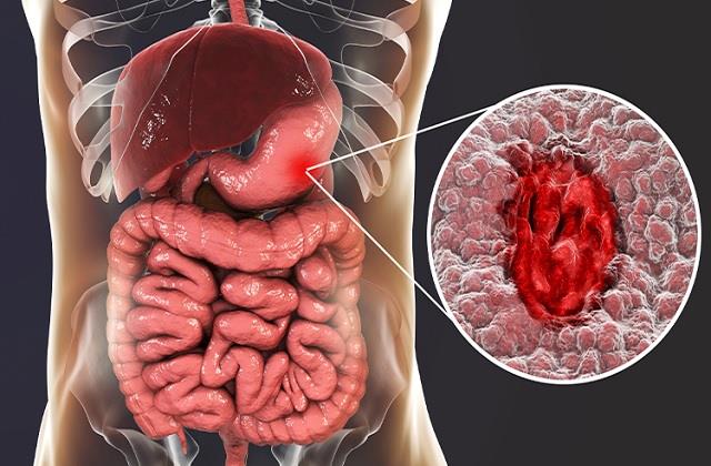 पेट में अल्सर के ये 5 संकेत, समय रहते पहचानना है बेहद जरूरी