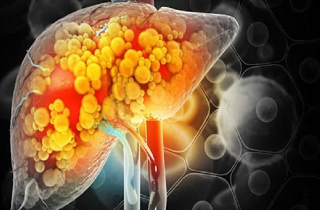 फैटी लिवर में क्या खाएं और क्या नहीं? डाइट से ऐसे घटाएं लिवर की चर्बी