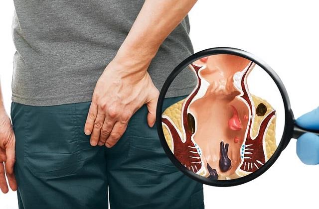 बवासीर के दर्द से परेशान यो इस तेल को मस्सों पर लगाएं, तुरंत मिलेगी राहत