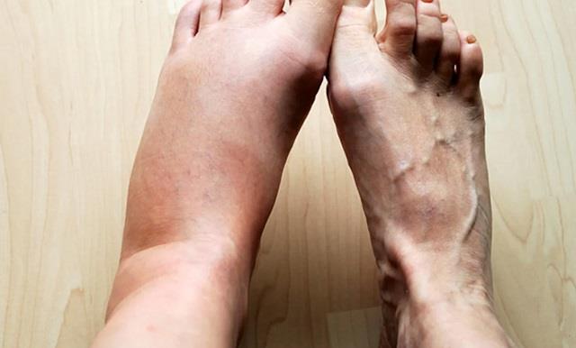 अगर बार-बार सूजते हैं पैर तो न करें Ignore, इस गंभीर बीमारी का हो सकता है संकेत