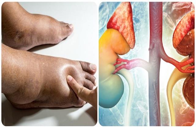अचानक फेल नहीं होती Kidney, पहले शरीर देता है ये 5 इशारे