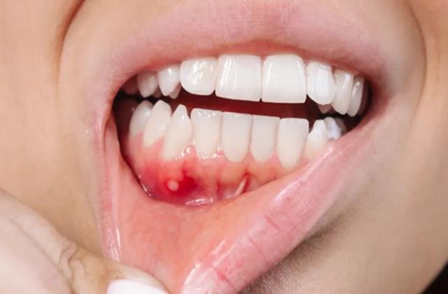 मामूली छाले समझकर कहीं कैंसर को तो नहीं कर रहे इग्नोर? मुंह के इन बदलावाें पर रखो नजर