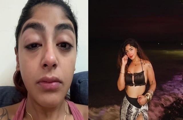 दांत टूटा, आंख सूजी…स्प्लिट्सविला फेम कंटेस्टेंट पर क्लब में हमला, सुनाई आपबीती