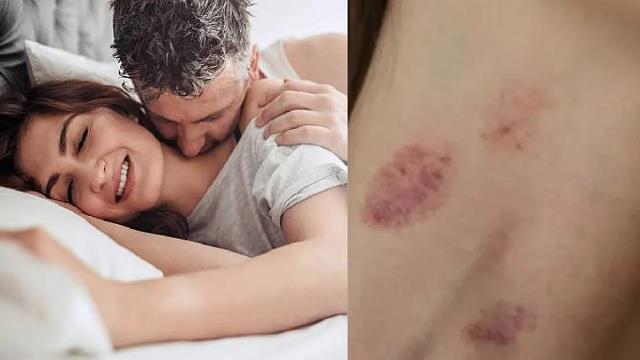 कब खतरनाक हो सकता है ‘लव बाइट’, जानें कब पार्टनर को रोकना होता है जरूरी?