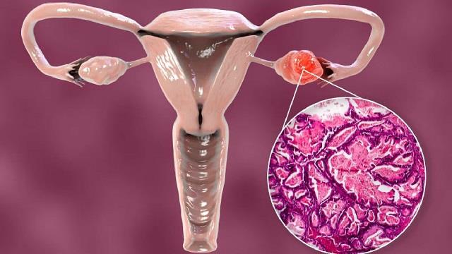 Ovarian Cancer को क्यों कहते हैं इसे ‘साइलेंट किलर’? क्या हैं इसके लक्षण