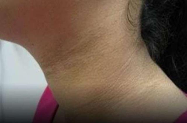 सिर्फ मैल नहीं इस बीमारी के कारण बच्चों की गर्दन रहती है काली, समझो इस चेतावनी को