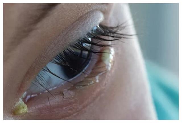 सुबह आंखों में जमने वाला मैल नॉर्मल नहीं? इस बीमारी का संकेत