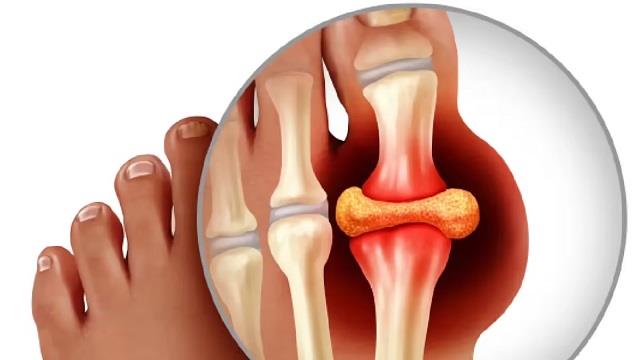 High Uric Acid से बचना है तो ना खाएं ये चीजें!