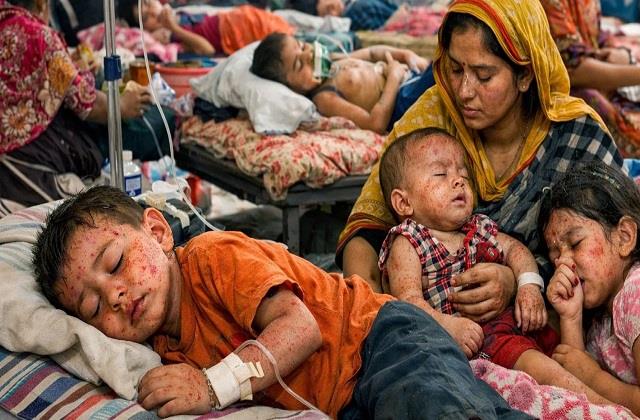 बांग्लादेश में खसरे का प्रकोप: 100 से ज्यादा बच्चों की मौत, जानें इसके लक्षण