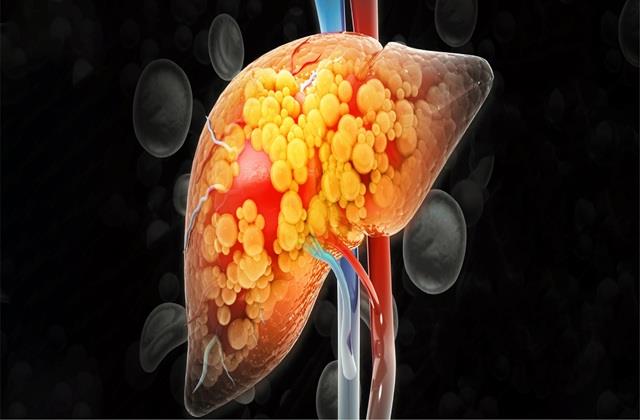 हर 5 में से 1 भारतीय को बिना शराब पिए है फैटी लिवर, क्यों इतनी आम हो गई ये बीमारी