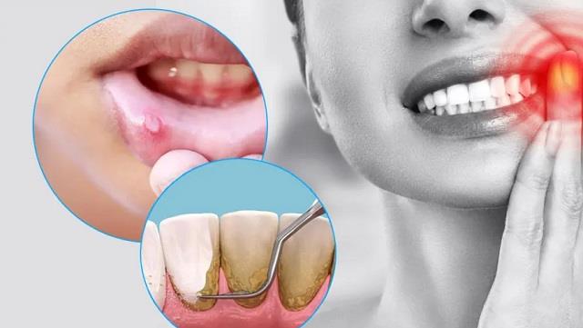 मसूड़े आपको दिल की बीमारी दे सकते हैं...