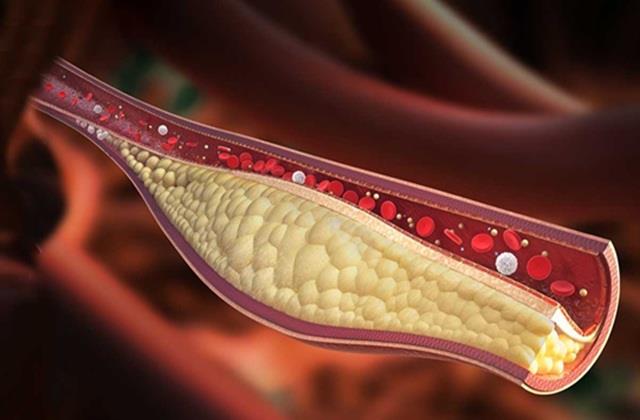 Cholesterol से बचने के लिए बस ये दो रुलस कर लो फॉलो, उम्र भर दवाइयों की नहीं पड़ेगी जरूरत