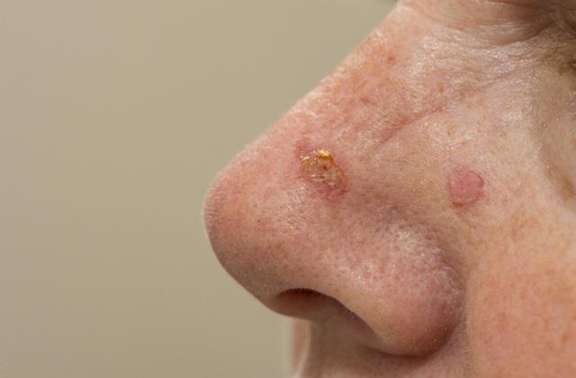 Face  के छोटे-छोटे धब्बे होते हैं Skin Cancer की निशानी, बीना दर्द और लक्षण के बढ़ती है ये बीमारी