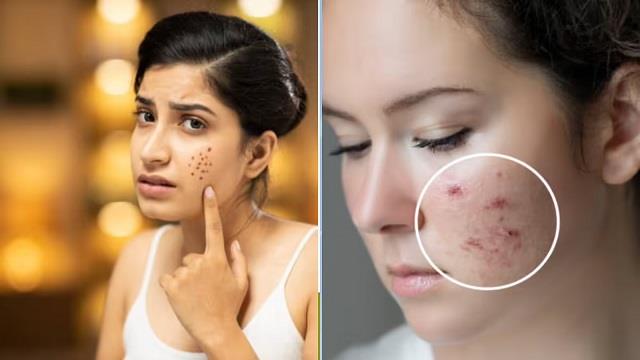 पिंपल्स के बाद रह गए हैं जिद्दी दाग तो कैसे हटाएं?