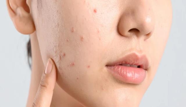 Nuts से ही नहीं ब्रेड, नमक और चीनी से भी होते हैं  Pimples, आज ही छोड़ दो इन चीजों को